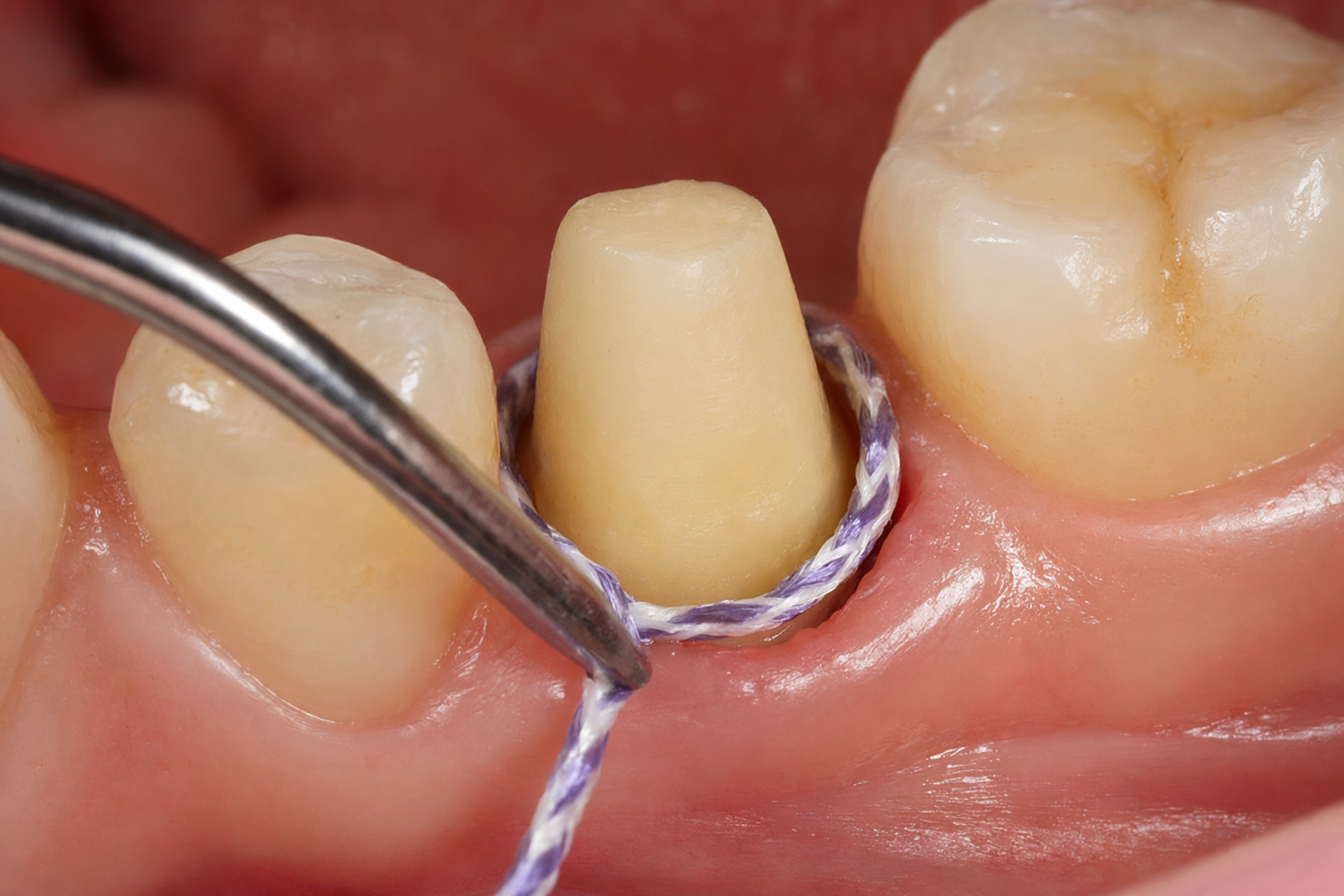 dentist placing retraction cord in gingival sulcus around prepared tooth