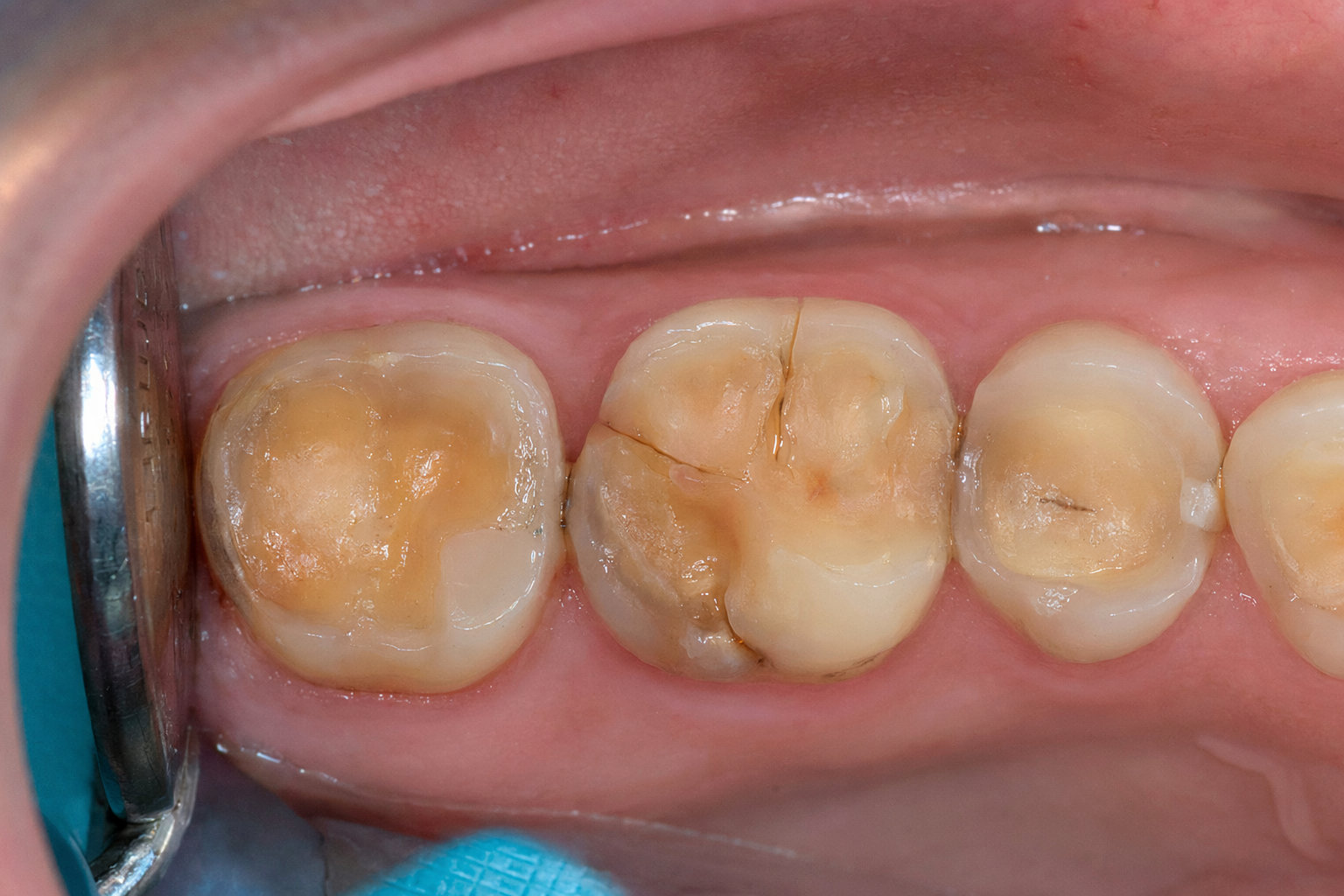 severely worn posterior teeth showing enamel attrition and occlusal damage from excessive bite force