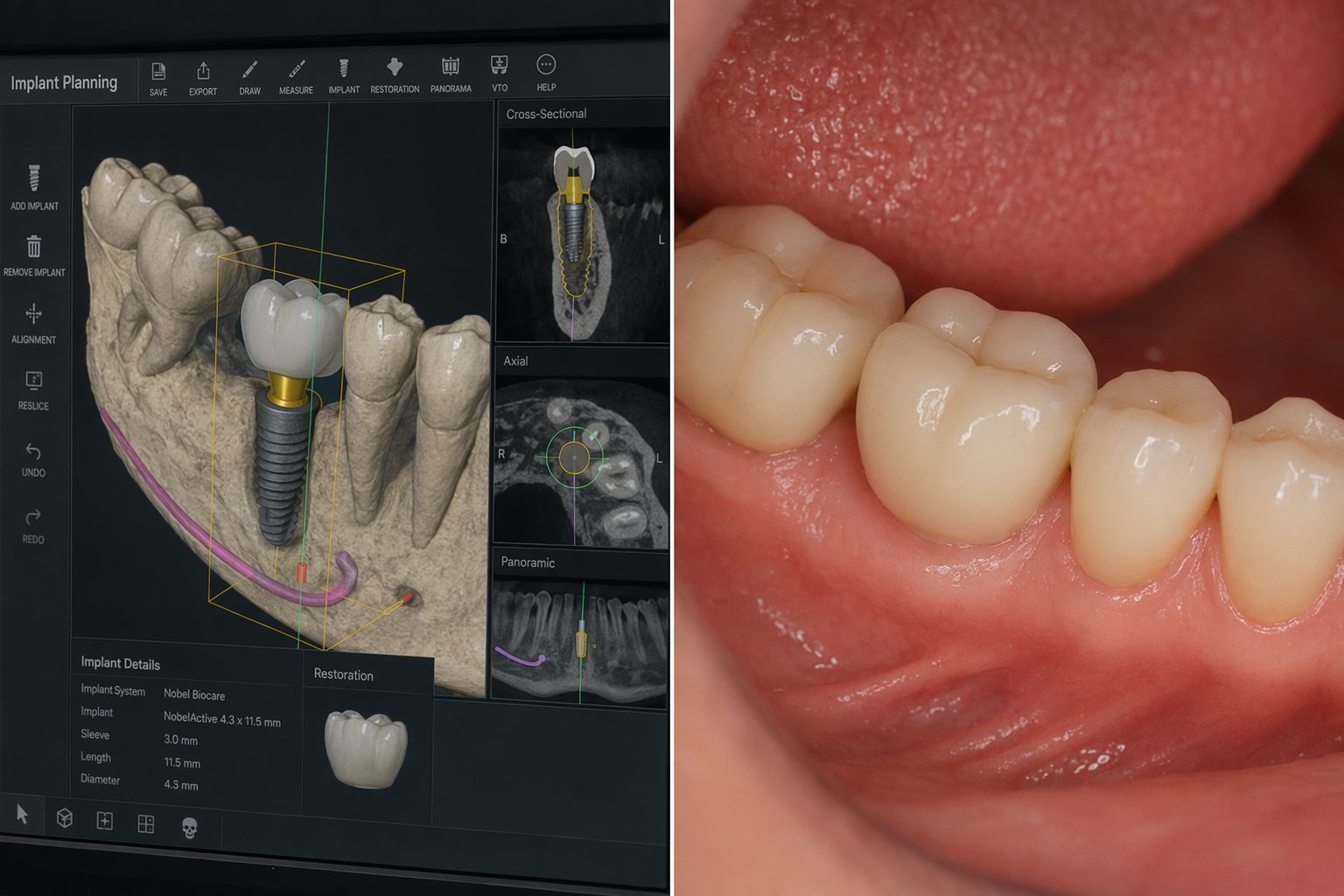 software pro virtuální plánování implantátů vlevo, finální implantátová korunka in situ vpravo