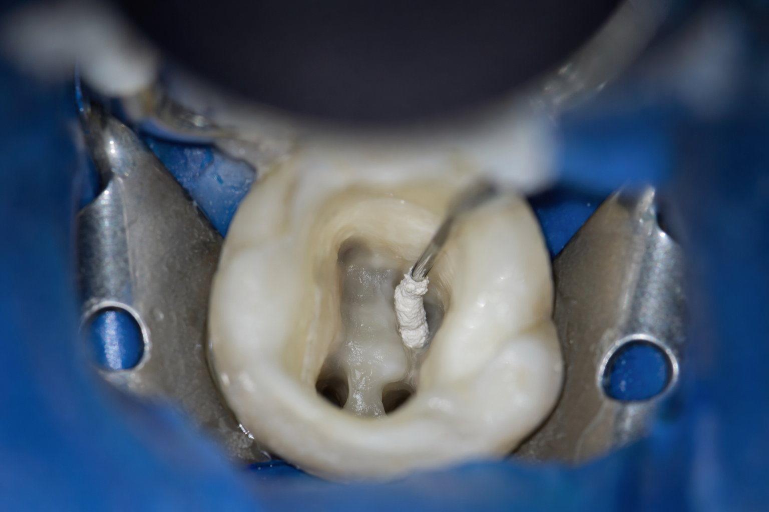 dentist applying white MTA material into root canal under magnification