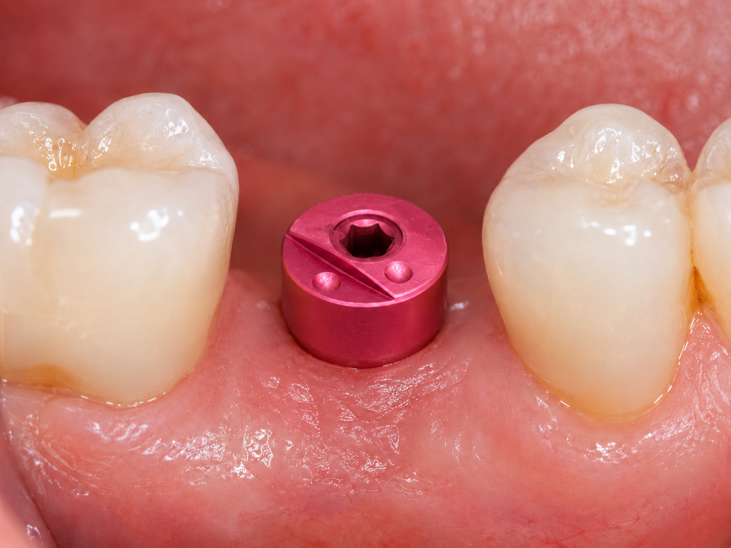 Léčebný abutment ZimVie Encode zobrazující jedinečný kódovaný povrchový vzor používaný pro digitální identifikaci implantátu