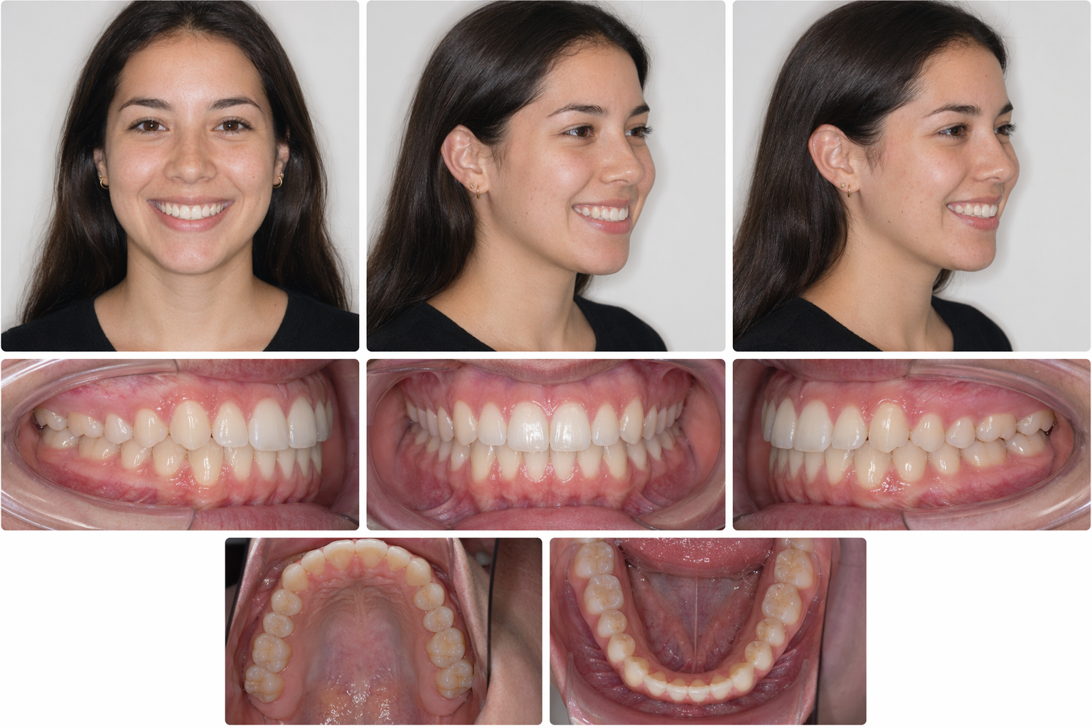 set of intraoral clinical photos taken during initial dental examination