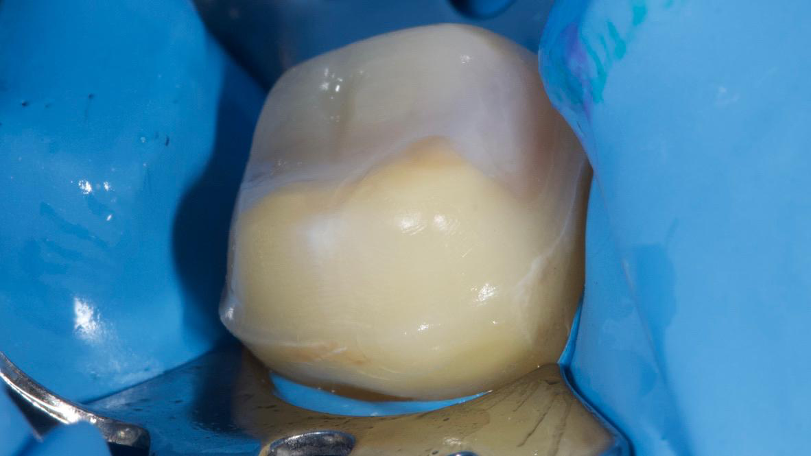 ceramic restoration on a tooth isolated under a rubber dam during adhesive cementation