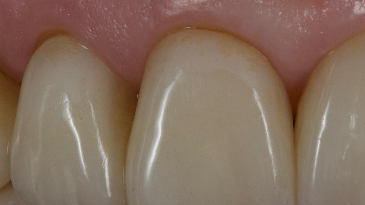 macro detail of ceramic crown surface with visible glaze degradation and fine scratches