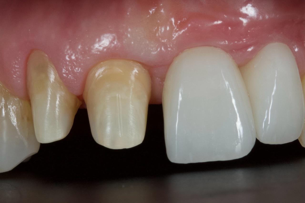 dentist drying a prepared tooth stump with air syringe prior to crown cementation